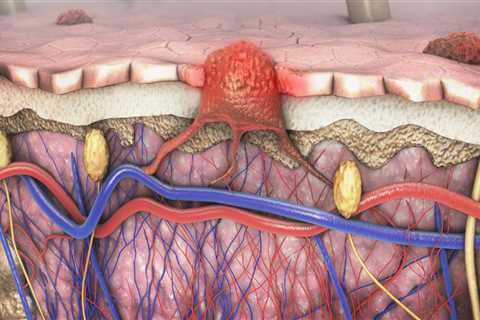 When will mesothelioma be cured?