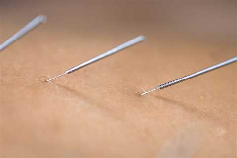 ACUPUNCTURE FOR MENOPAUSE SYMPTOMS: WHAT YOU NEED TO KNOW