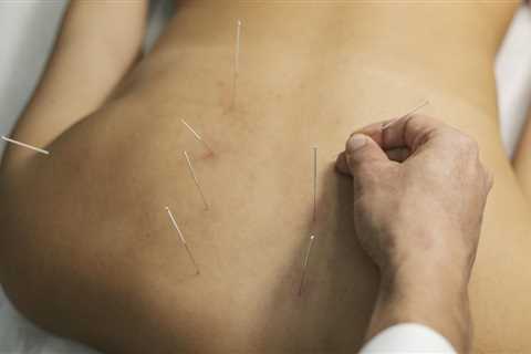 HOW TO INCORPORATE ACUPUNCTURE INTO YOUR WORKPLACE WELLNESS PROGRAM