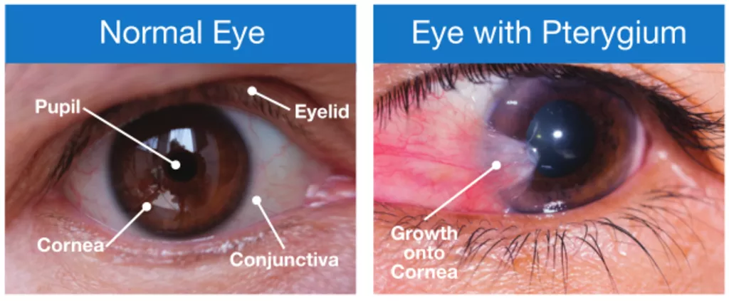 Seeing Clearly: Article III Standing of IPR Judicial Review